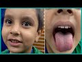 ছোট্ট বাবুটি রাতে হা করে ঘুমায় যে সমস্যার কারনে | Malleus ENT Specialized Hospital Ltd