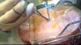 tomo biopsy movie