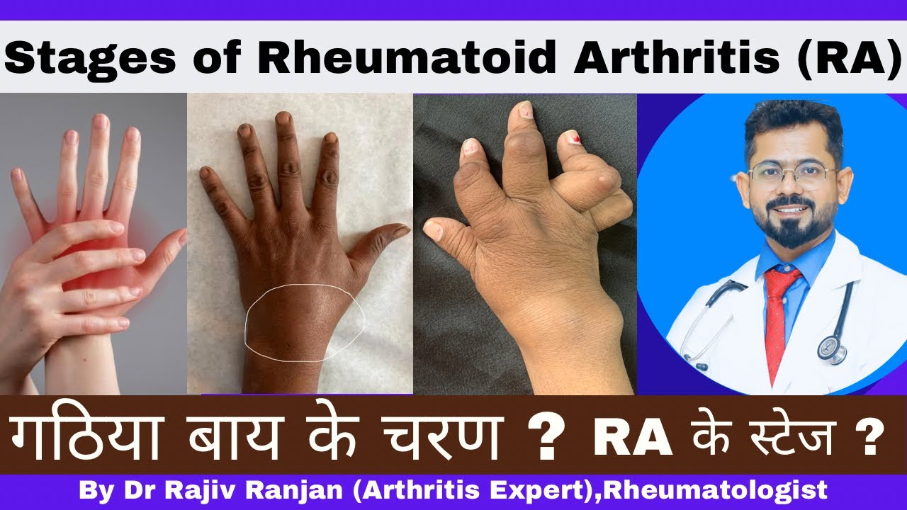 रूमेटाइड गठिया के चरण ? Stages of Rheumatoid Arthritis ? YouTube