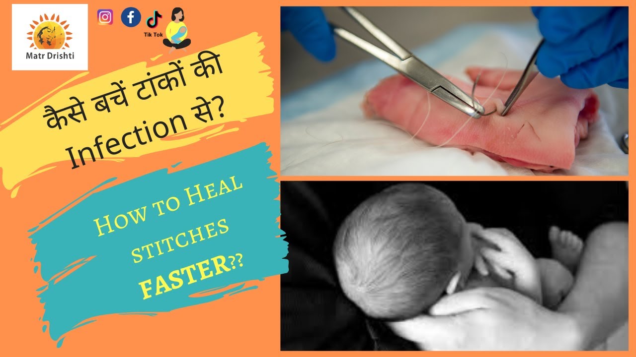 how to take care of stitches after delivery