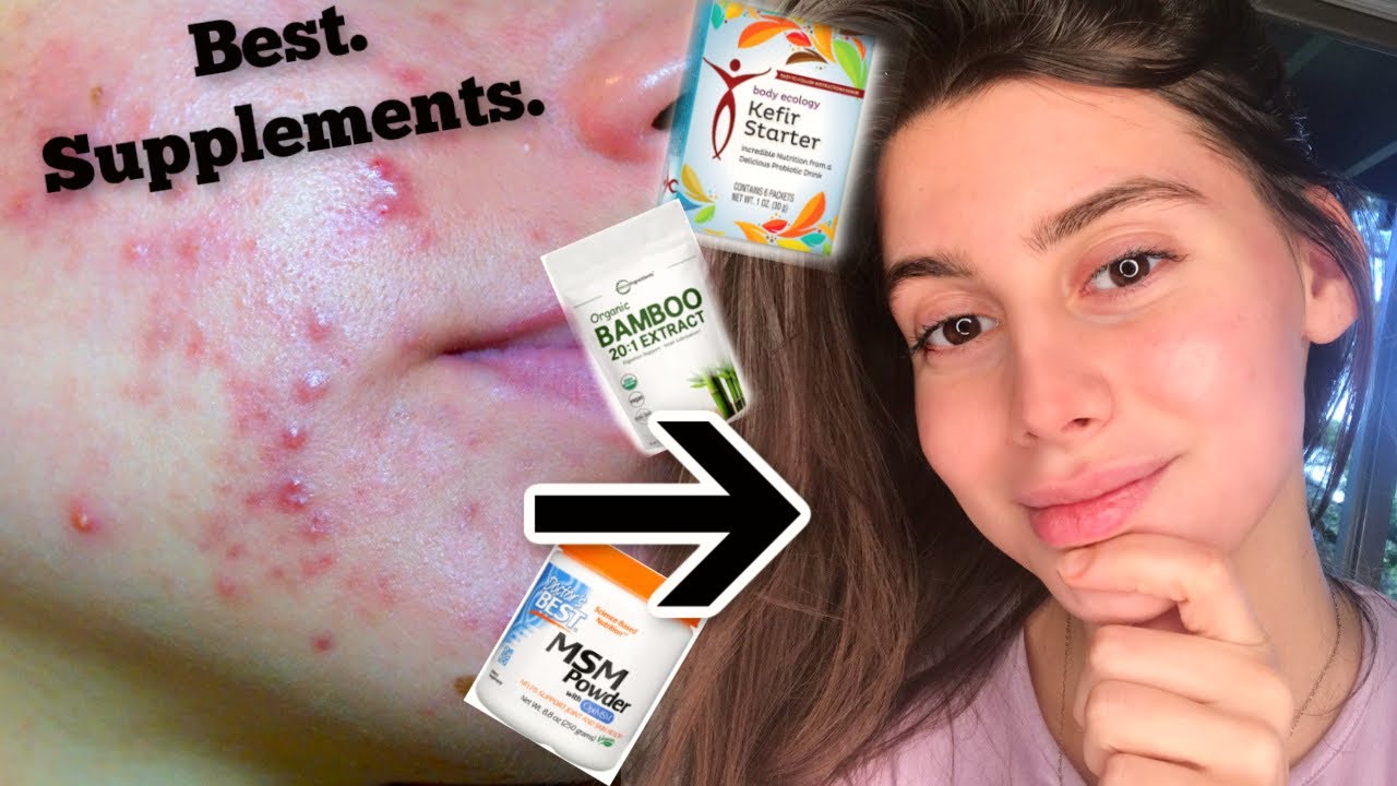 THE BEST SUPPLEMENTS FOR CLEAR AND GLOWY SKIN!! MSM, Vitamin D, and