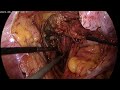 laparoscopic radical hysterectomy partIII