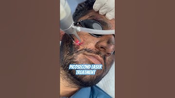 Pico second laser treatment #viralyoutubevideo  #viralyoutubevideo #melasmatreatment