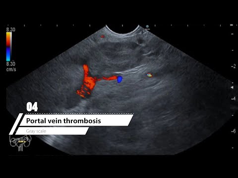 04 CoM April '22 - Portal vein thrombosis