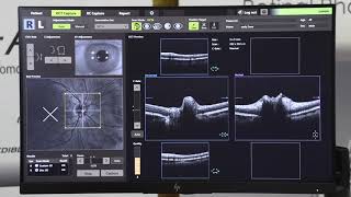 ¡Cuáles son las ventajas del OCT A1 Canon explicadas por el Dr Ben Szirth