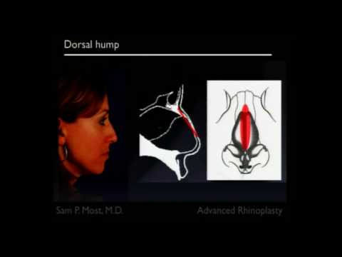Video thumbnail: San Francisco Advanced Rhinoplasty (Part 6 - Dorsal Hump) — sammost