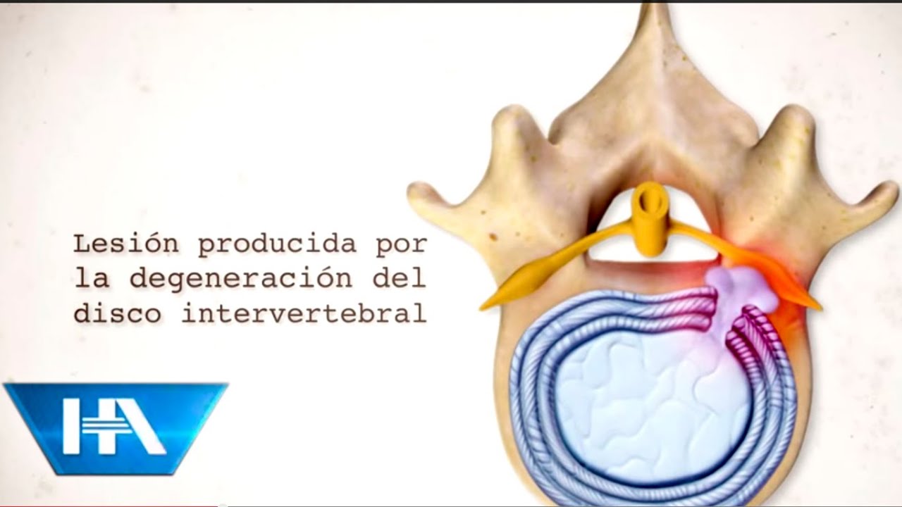 La hernia discal y su tratamiento YouTube