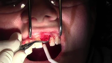 Extraction #9 with GBR-Socket Grafting, Pouch Technique, II