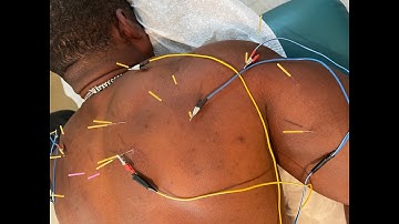 Dry Needling and Acupuncture with eStim a Body Builder