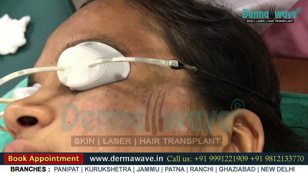 Nevus of Ota Treatment | Birthmark Removal by Laser | Panipat | Jammu | New Delhi | Patna -Dermawave