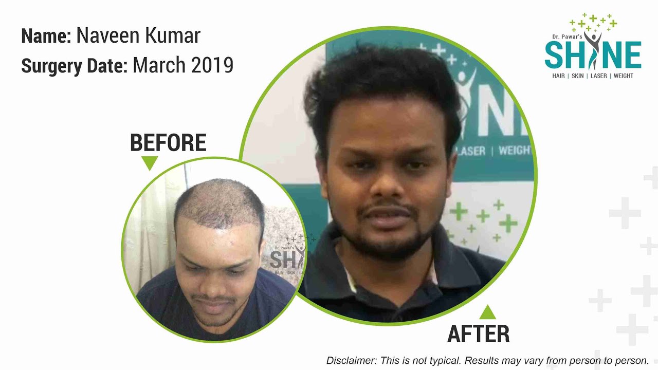 Hair Specialist in Indore  Hair Loss Doctors in Indore