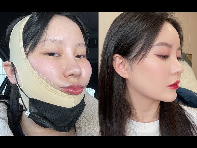 【面部吸脂手术大干货】我天！术后对比超级明显！面部吸脂会不会变面瘫？什么样的脸适合抽脂？| Sayi Makeup