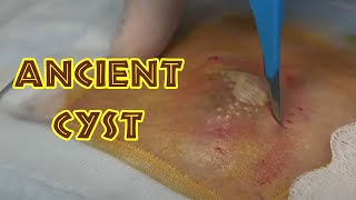 Cherub's Ancient 40 Year-Old Cyst Finally Treated!