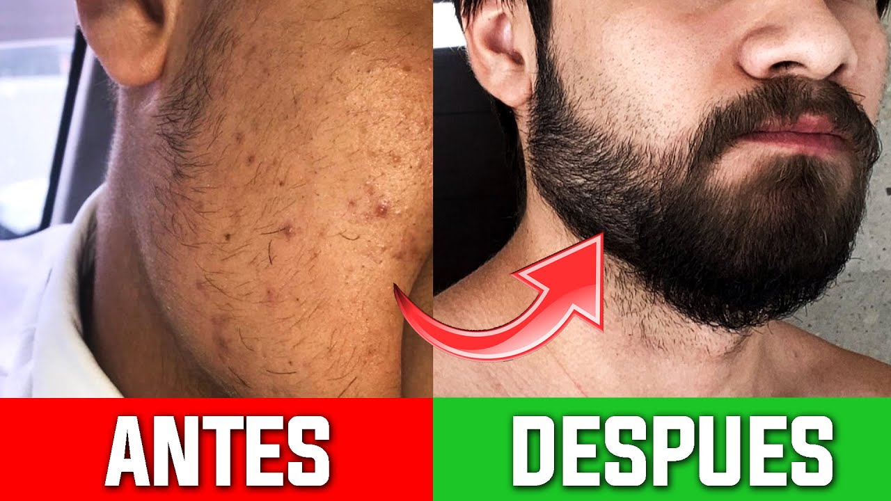 TOP BARBAS DE MINOXIDIL INCREIBLES!! 😱 #2