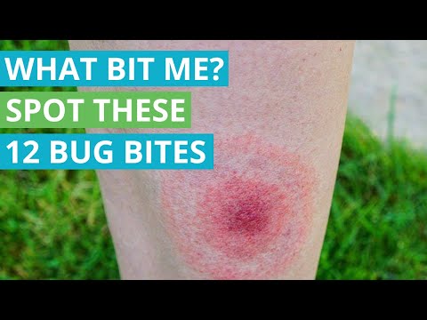 Video: How to Identify Insect Bites: 15 Steps (with Pictures)