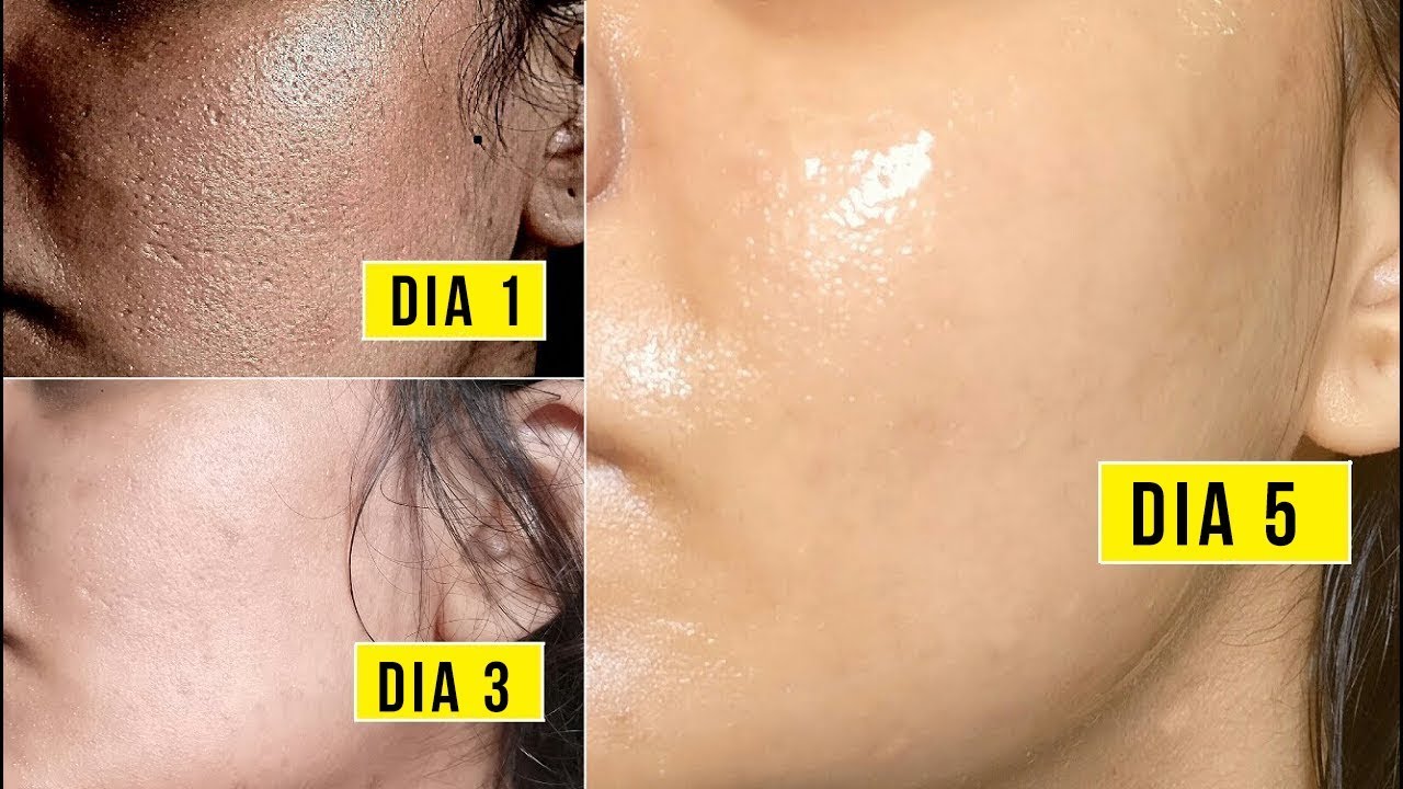videos de belleza para el cabello Repara Tu piel en 5 DÍAS CHALLENGE | Cierra los Poros Abiertos, Elimina Espinillas y Reduce Arrugas