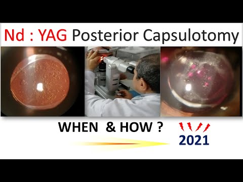 Nd-YAG Posterior Capsulotomy  (#015 )