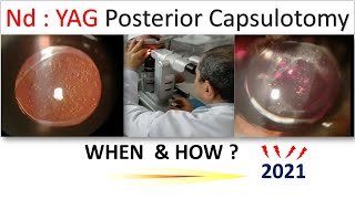Nd-Yag Posterior Capsulotomy