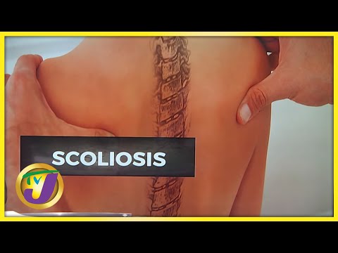 Get Screened for Scoliosis with Dr. Andrew Bogle | TVJ News - June 1 2022
