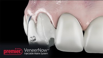 VeneerNow™ Injectable Matrix System