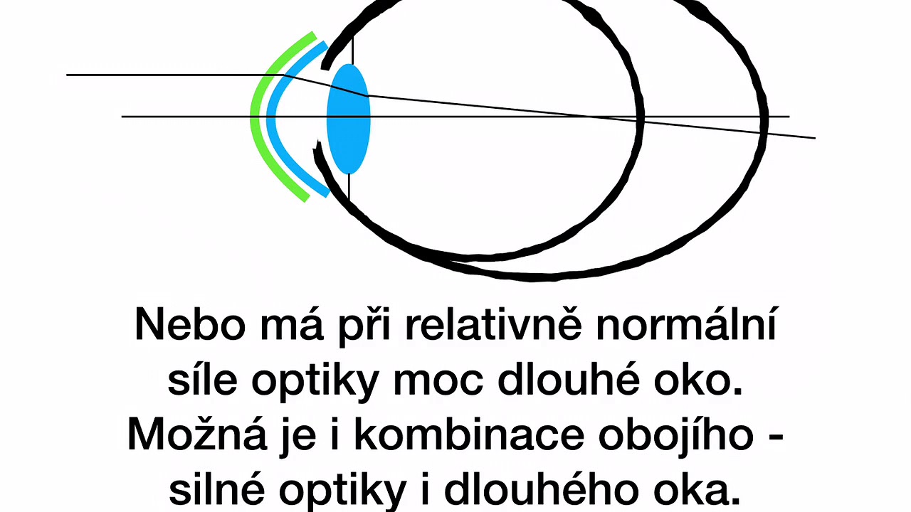 myopia 4 dioptria mennyi