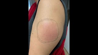 Vaccine side effect "COVID arm" can develop later in some people Profile