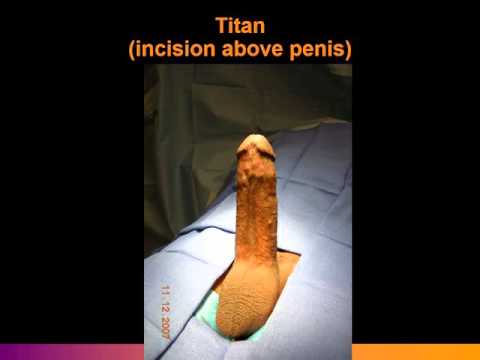 Penis Implant Video 108