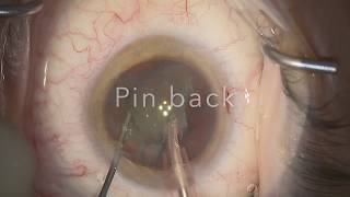 Deconstructing cataract surgery 6 - Phacoemulsification