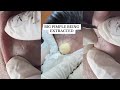 10 minutes of top asmr pimple popping