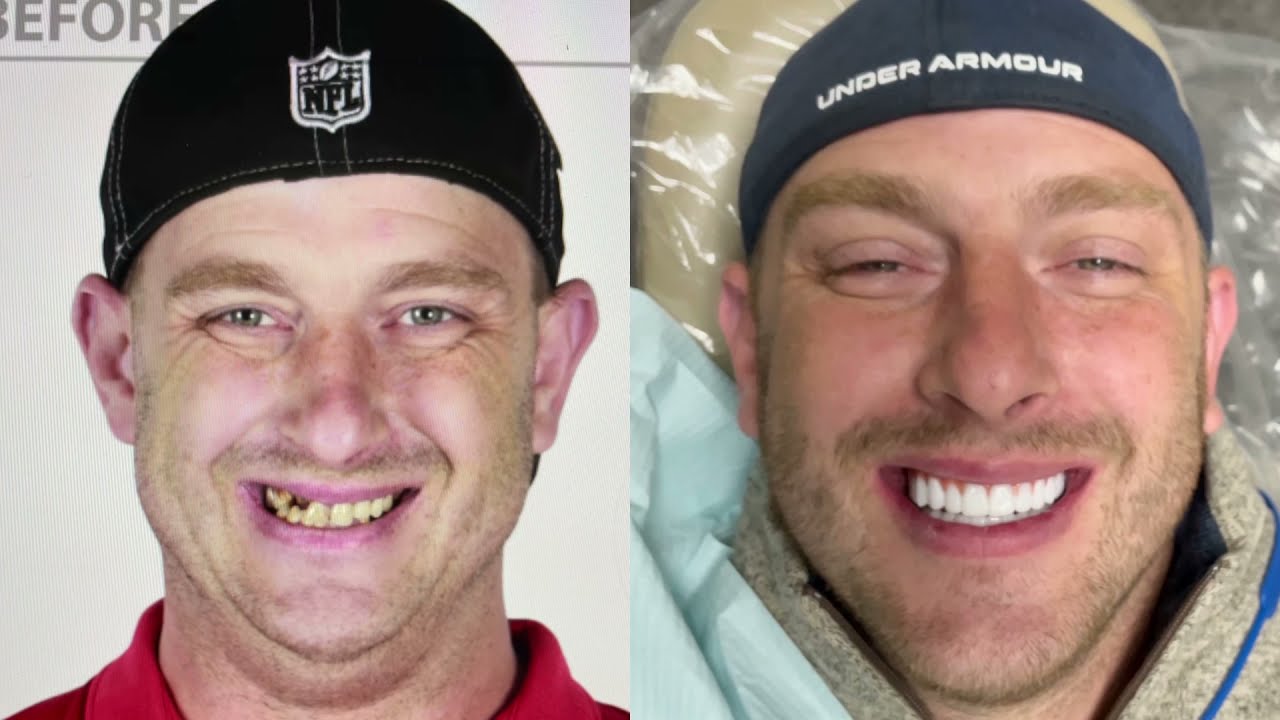 Jack’s ALL-ON-4 Smile Transformation