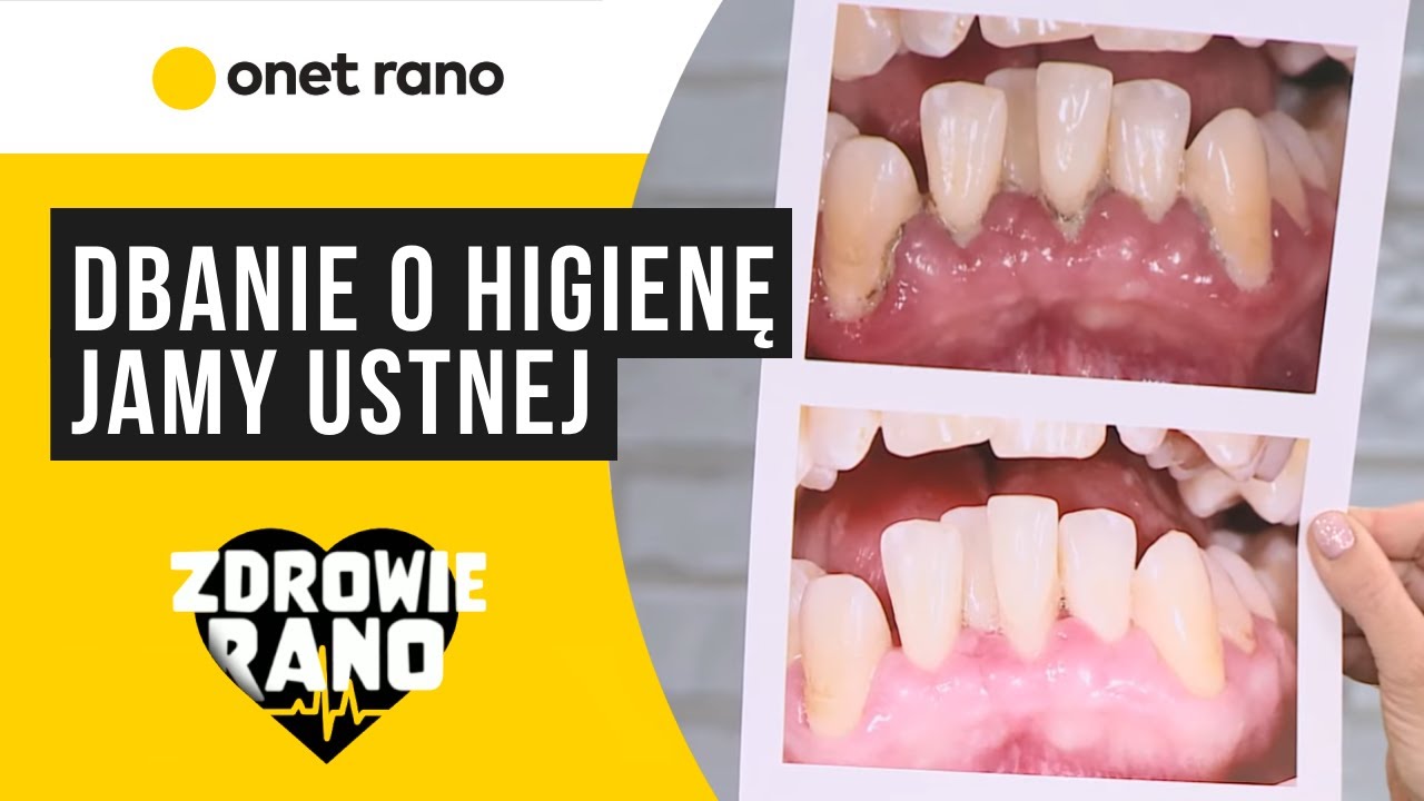 Jak dbać o higienę jamy ustnej nosząc aparat ortodontyczny? | Zdrowie Rano