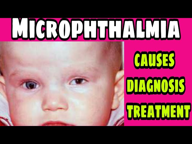 What Causes Microphthalmia