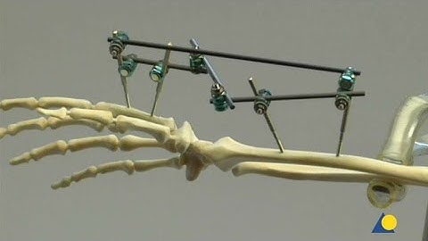 Radius, Distal - Fracture - Small External Fixator: Wrist-spanning Frame