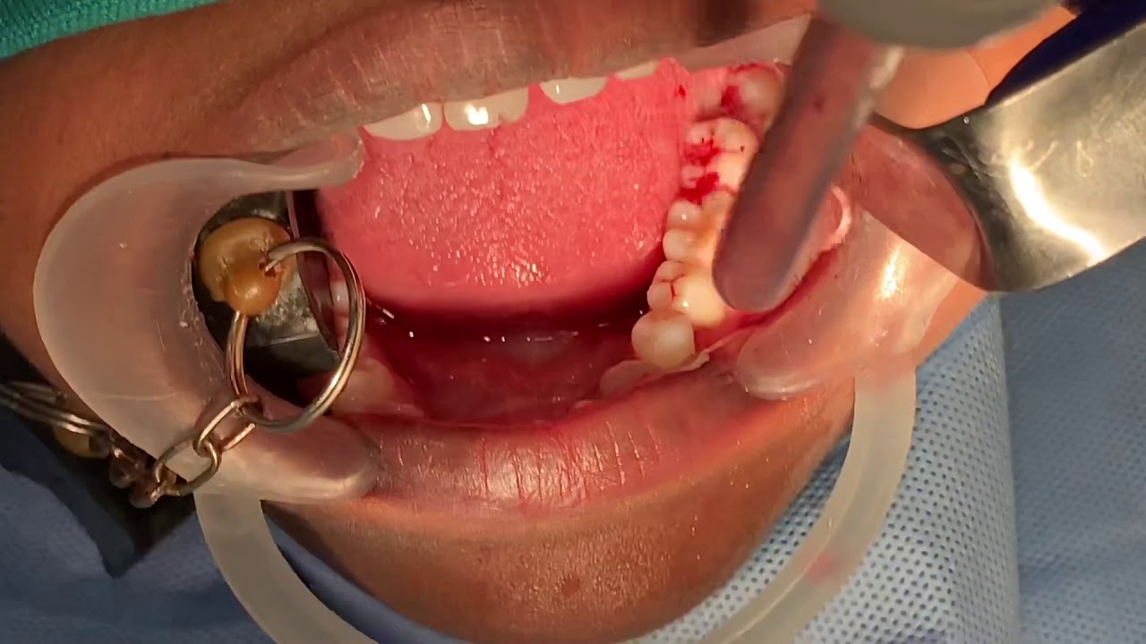 Odontectomy - technique to remove buried third molar wisdom tooth