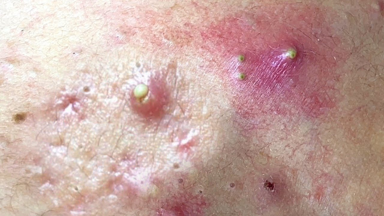 Blackheads & Milia, Big Cystic Acne Blackheads Extraction whiteheads Removal pimple Popping