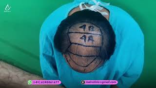 FUE Hair Transplant Marking & Planning || Dr. Jayanta Plastic & Cosmetic Surgeon | Bangladesh