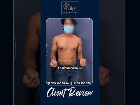 Patient Success Story: My Journey Overcoming Gynecomastia at Sculpt Aesthetics