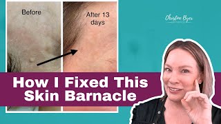 Shocking Cause of Pigmentation/ Barnacles & How I Fixed It! 🔥✨