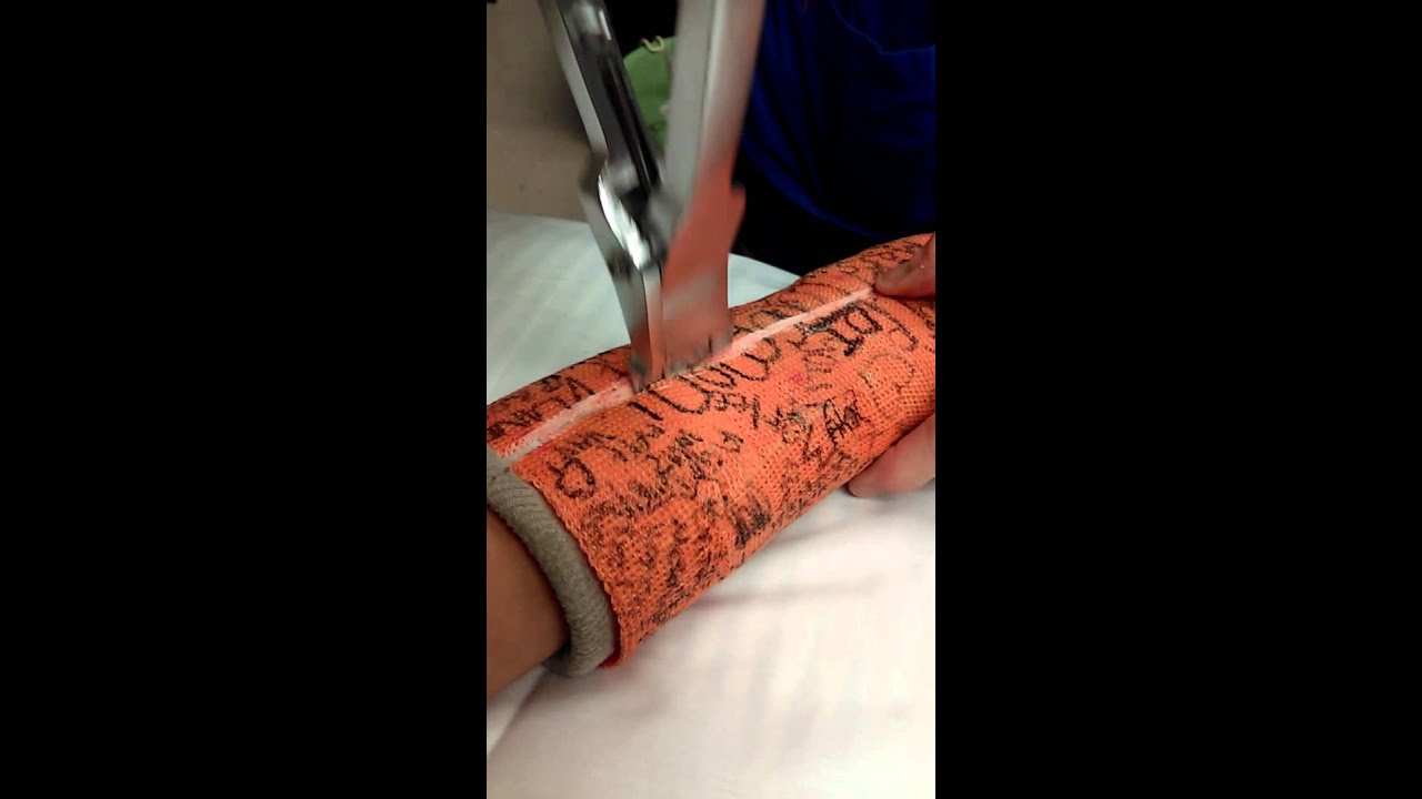 GETTING MY CAST OFF!!! YouTube