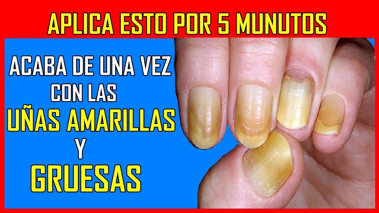 medicina natural para la gastritis Aplica ESTO por 5 minutos y acabe de 1 vez por todas con esas desagradables uñas gruesas y amarillas