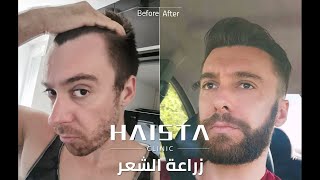 نتائج عمليات زراعة الشعر واللحية في تركيا | HAISTA CLINIC