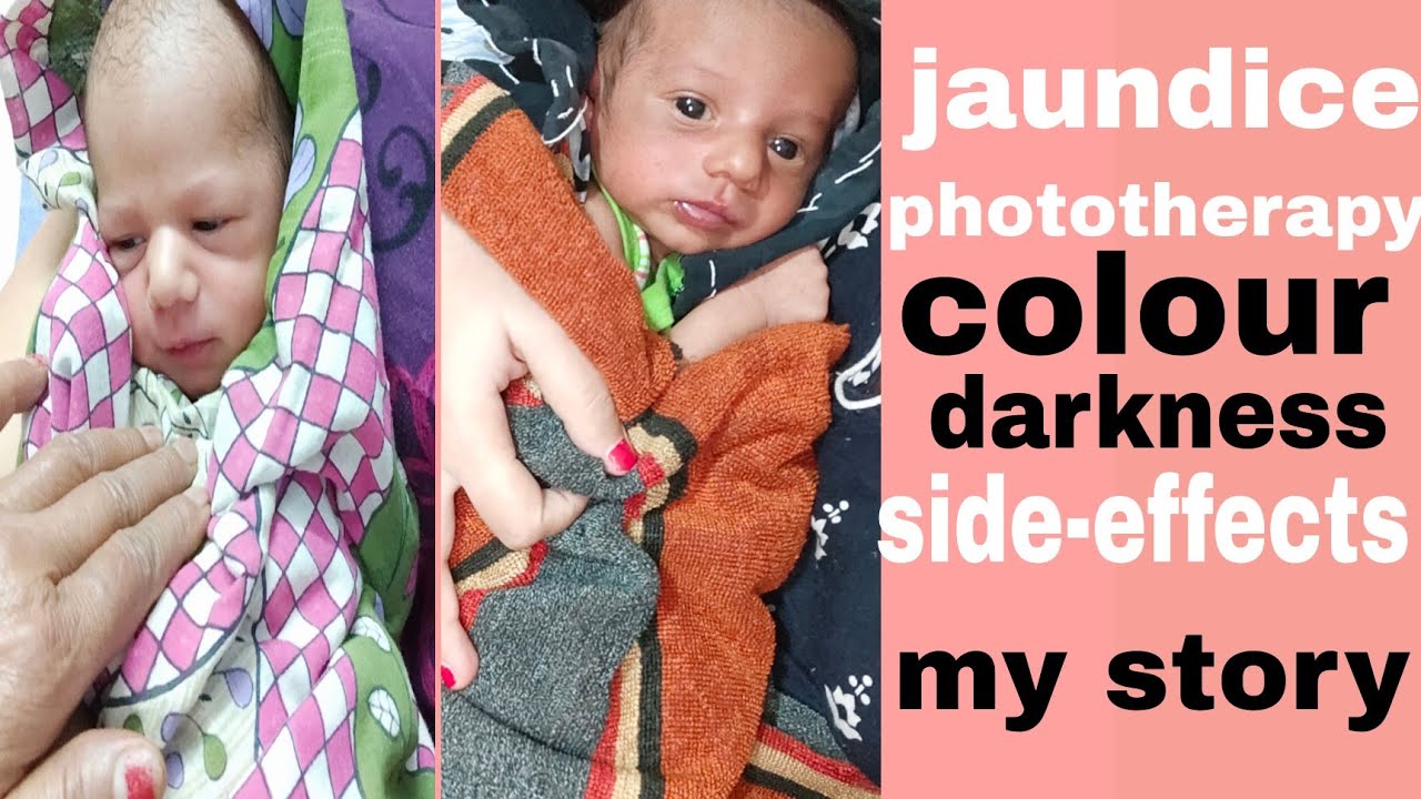 colour darkness after phototherapy in jaundice (??????????????????) of a newborn ...
