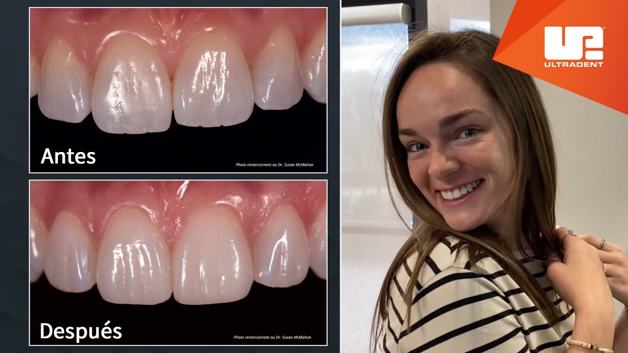 Uveneer and Uveener Extra | Sistema de moldes para la elaboración de carillas directas de composite