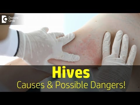 How is Hives diagnosed? Danger of Hives | Rash | Allergy|Urticaria- Dr.Rasya Dixit | Doctors&rsquo; Circle