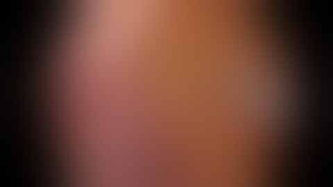 Laparoscopic RT. Heminephrectomy for upper pole moiety non functioning kidney