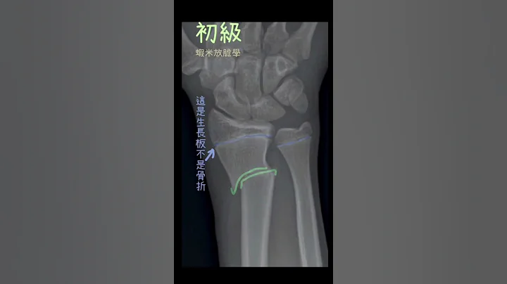 骨折X光醫學影像｜X ray fracture #xray - 天天要聞