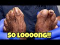 LONG TOENAILS CUTTING - SHE HAS A CALLUS TOO!!