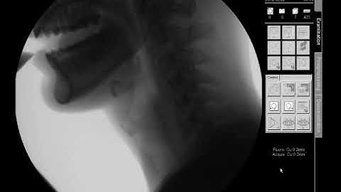 Swallow Study - Thin Liquid - Modified Barium Swallow Study (MBSS) - Lateral View HD