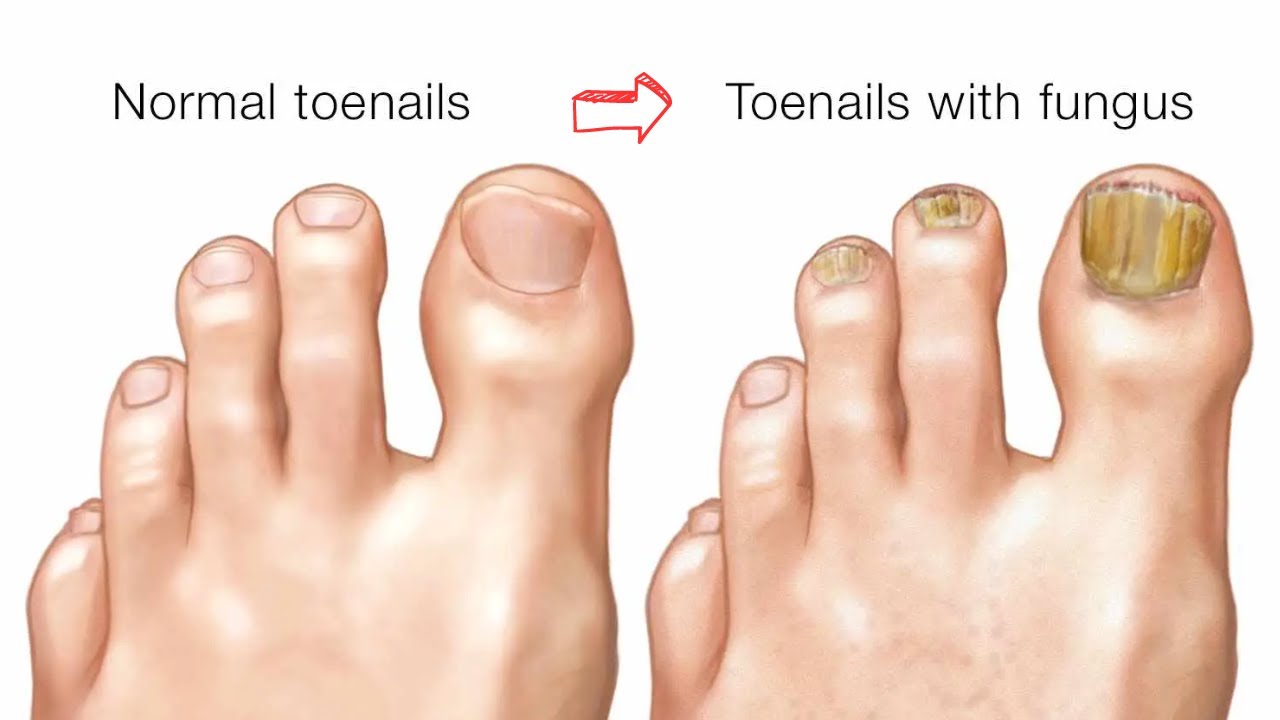 Urgent: 7-second “Fungus Vanishing” Ritual Renews Nails 3X Faster| Metanail Complex Review
