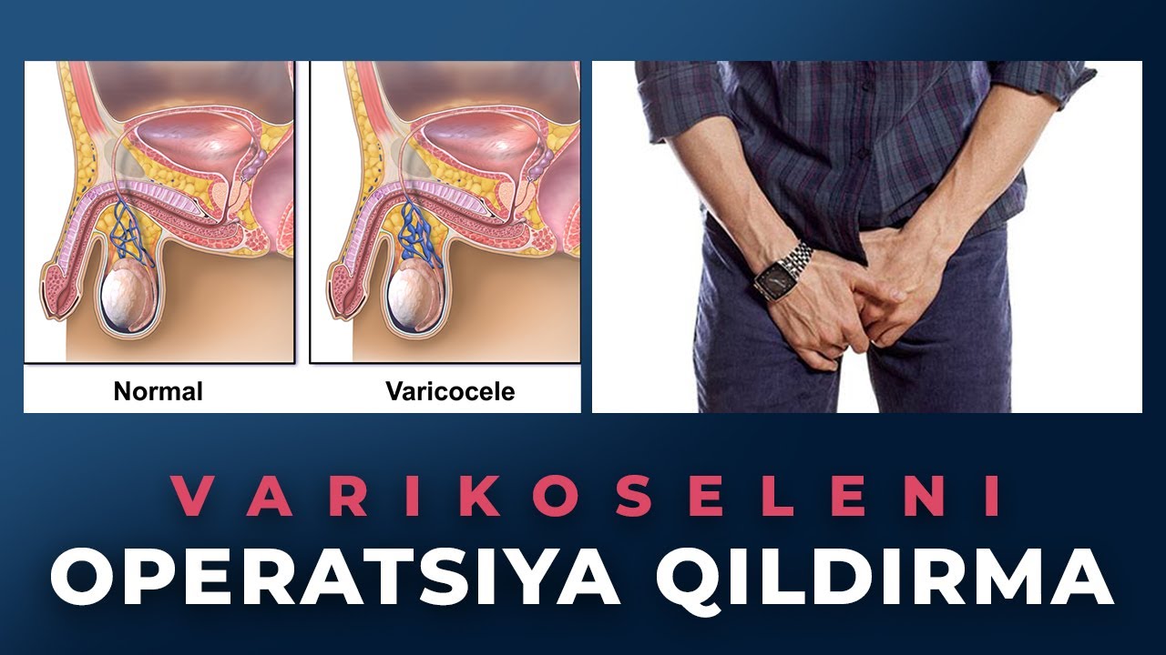 VARIKOSELENI OPERATSIYA QILDIRMA